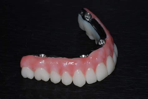 titanium dentures photos